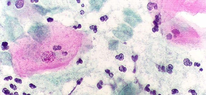 dientamoebiasis-nedir-brlirti-tani-ve-tedavisi-3121 Dientamoebiasis nedir? Brlirti, tanı ve tedavisi