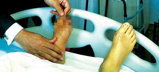diyabet-hastalari-el-ve-ayak-yaralarina-karsi-emg-cektirmeyi-ihmal-etmemeli-41885 Diyabet hastaları el ve ayak yaralarına karşı EMG çektirmeyi ihmal etmemeli!