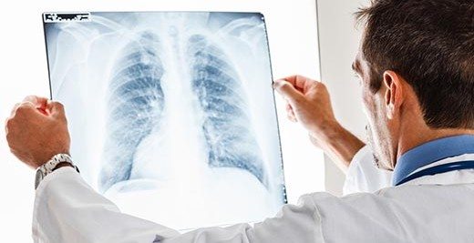immunoterapi-akciger-kanseri-tedavisinde-basariyi-cok-arttirdi-95676 İmmünoterapi akciğer kanseri tedavisinde başarıyı çok arttırdı
